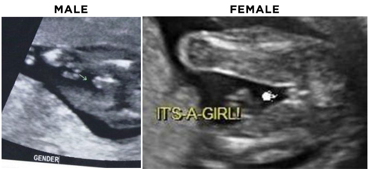 Ultrasound gender scan at 16th week pregnancy