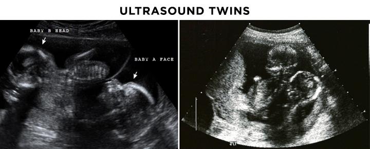 16th Week Pregnancy Ultrasound Gender Scan