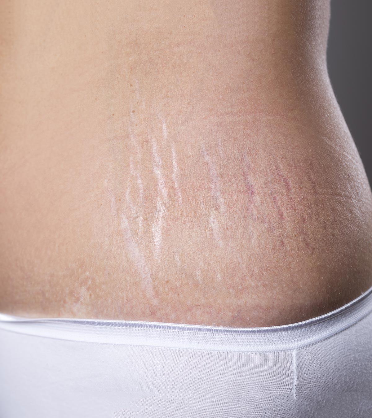 Removing Stretch Marks After Pregnancy