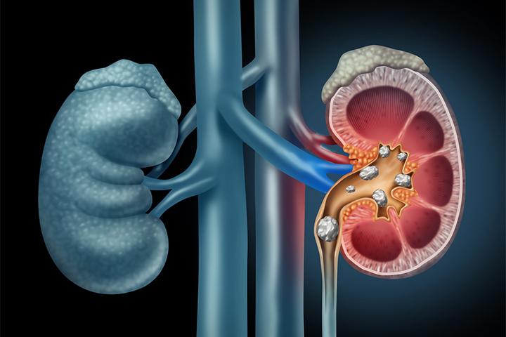 Papaya may cause kidney stones when eaten in excess.