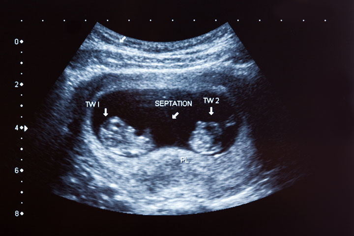 Twin ultrasound, 16 weeks pregnancy
