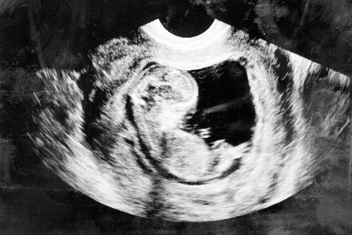 10th Week Pregnancy: Symptoms, Baby Development, Tips And Body Changes