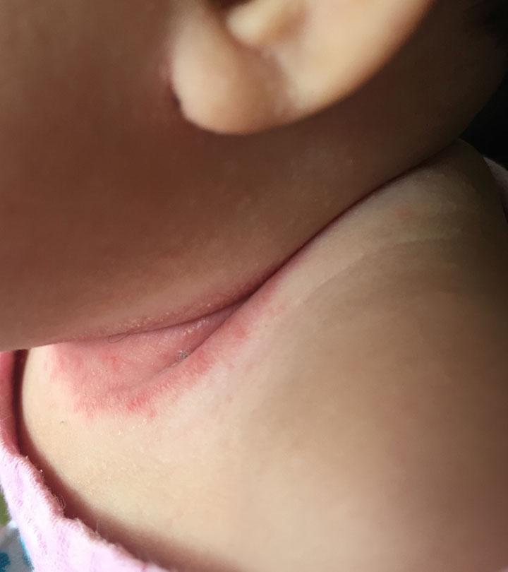 adult heat rash on neck