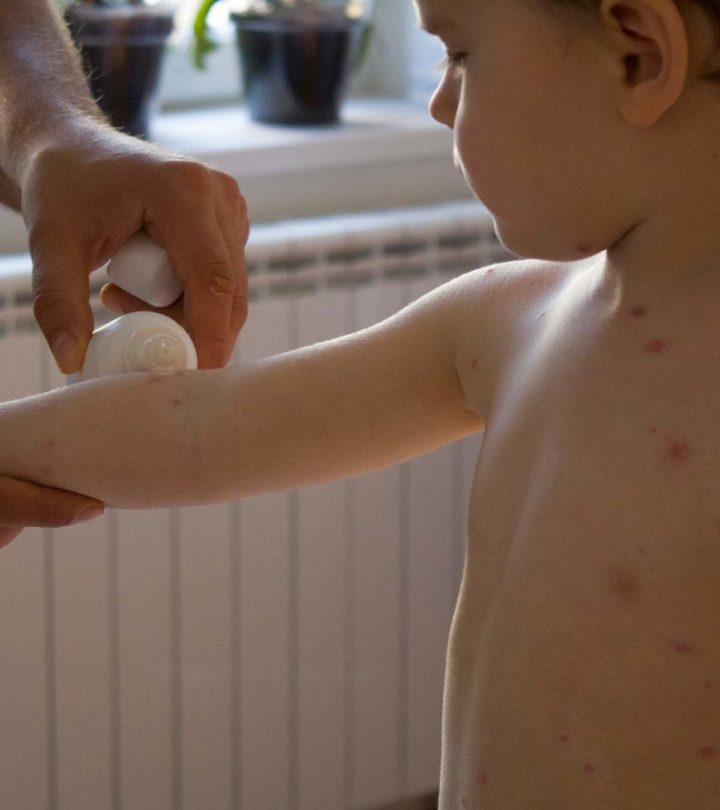Symptoms Of Smallpox In Children And Treatment Options