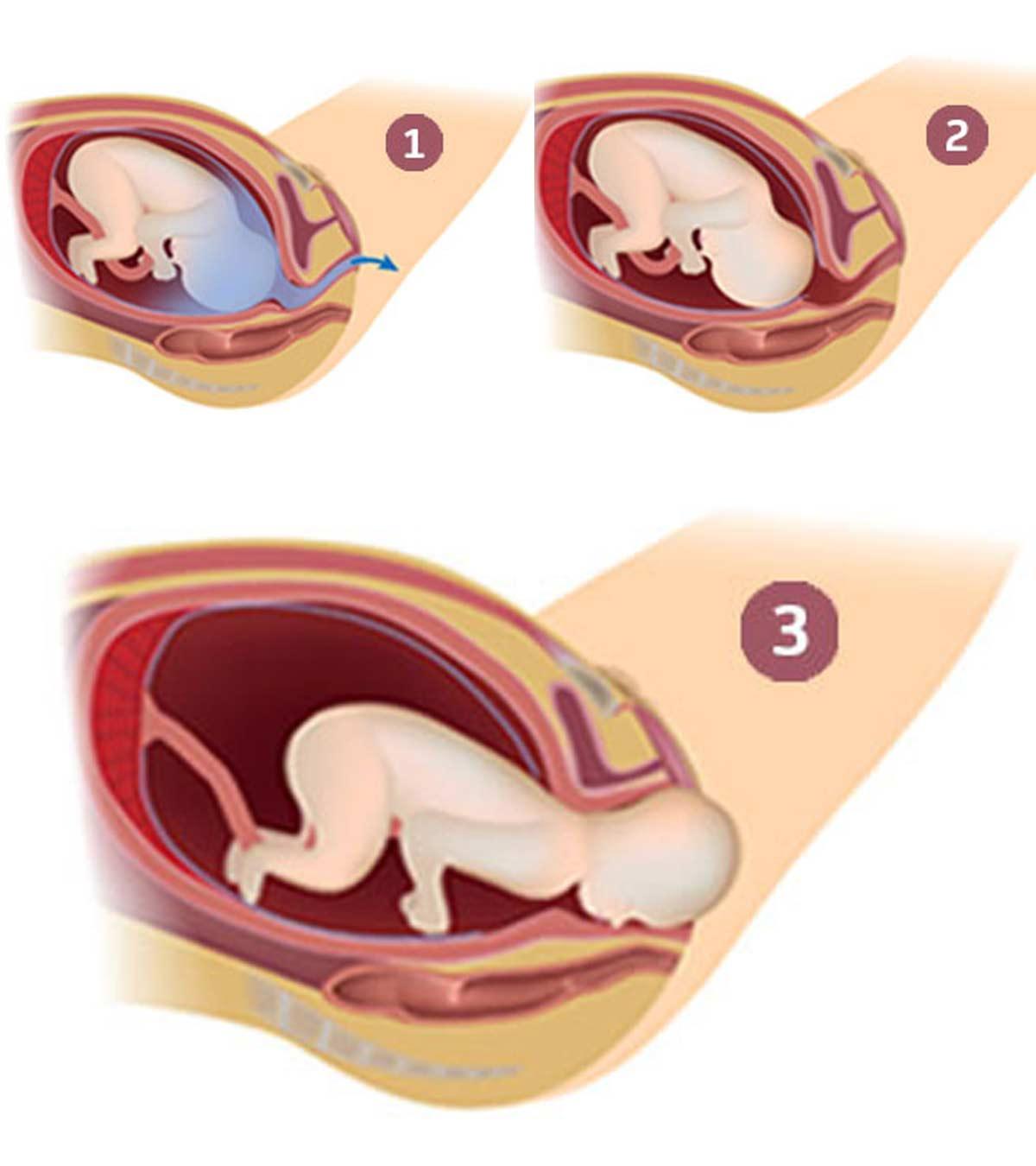 What Are Best Baby Birth Positions For Comfortable Delivery?