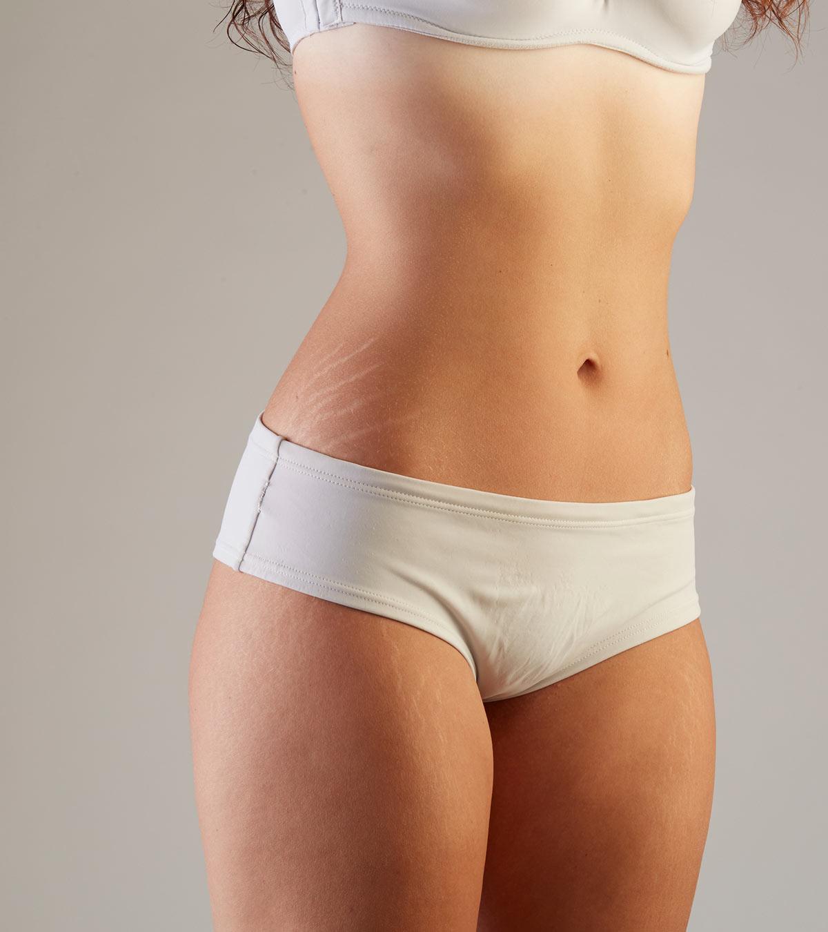 A teenager with stretch marks
