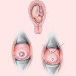 Cervical Cerclage Why And How Is It Done During Pregnancy