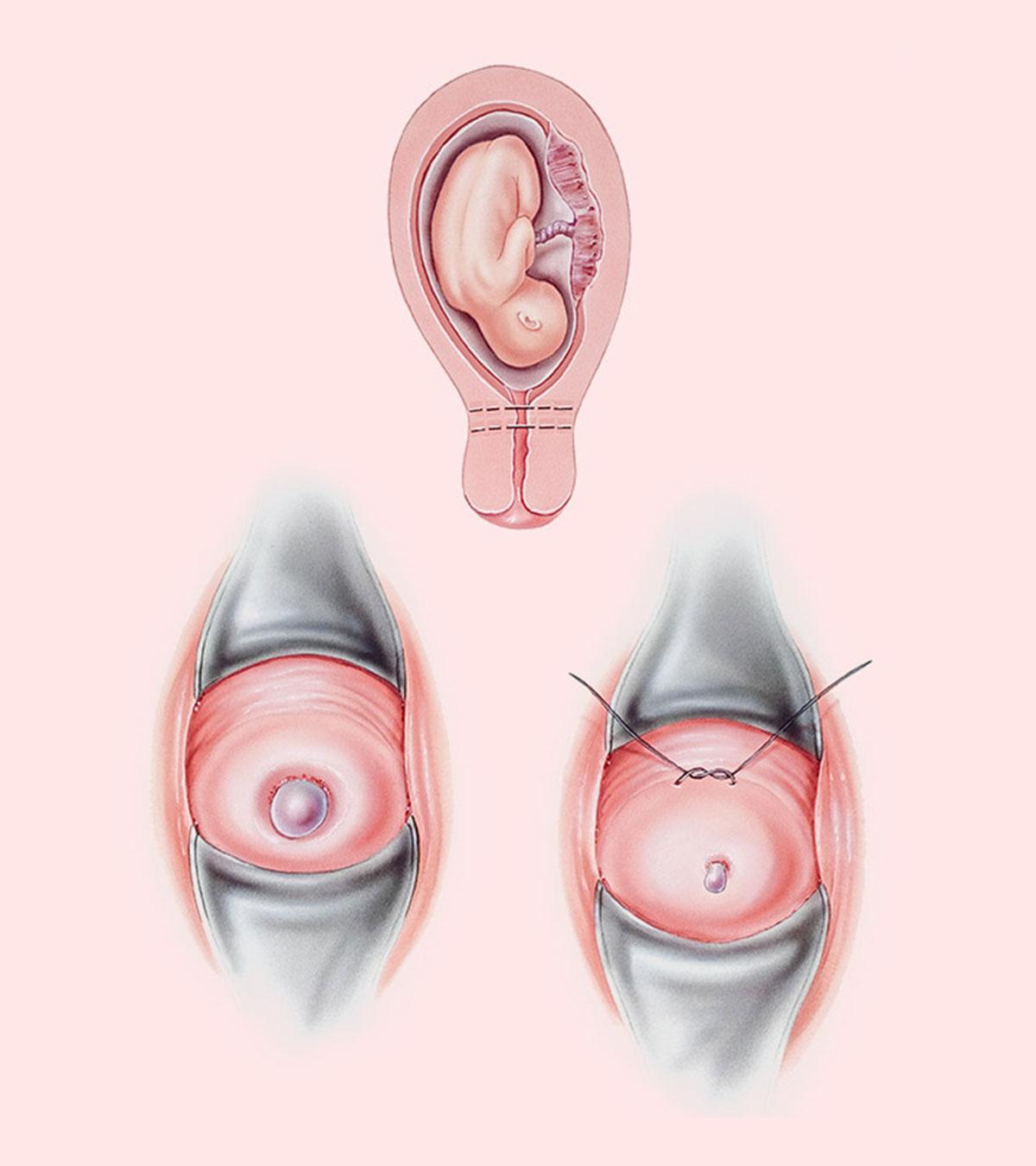 Cellulite During Pregnancy