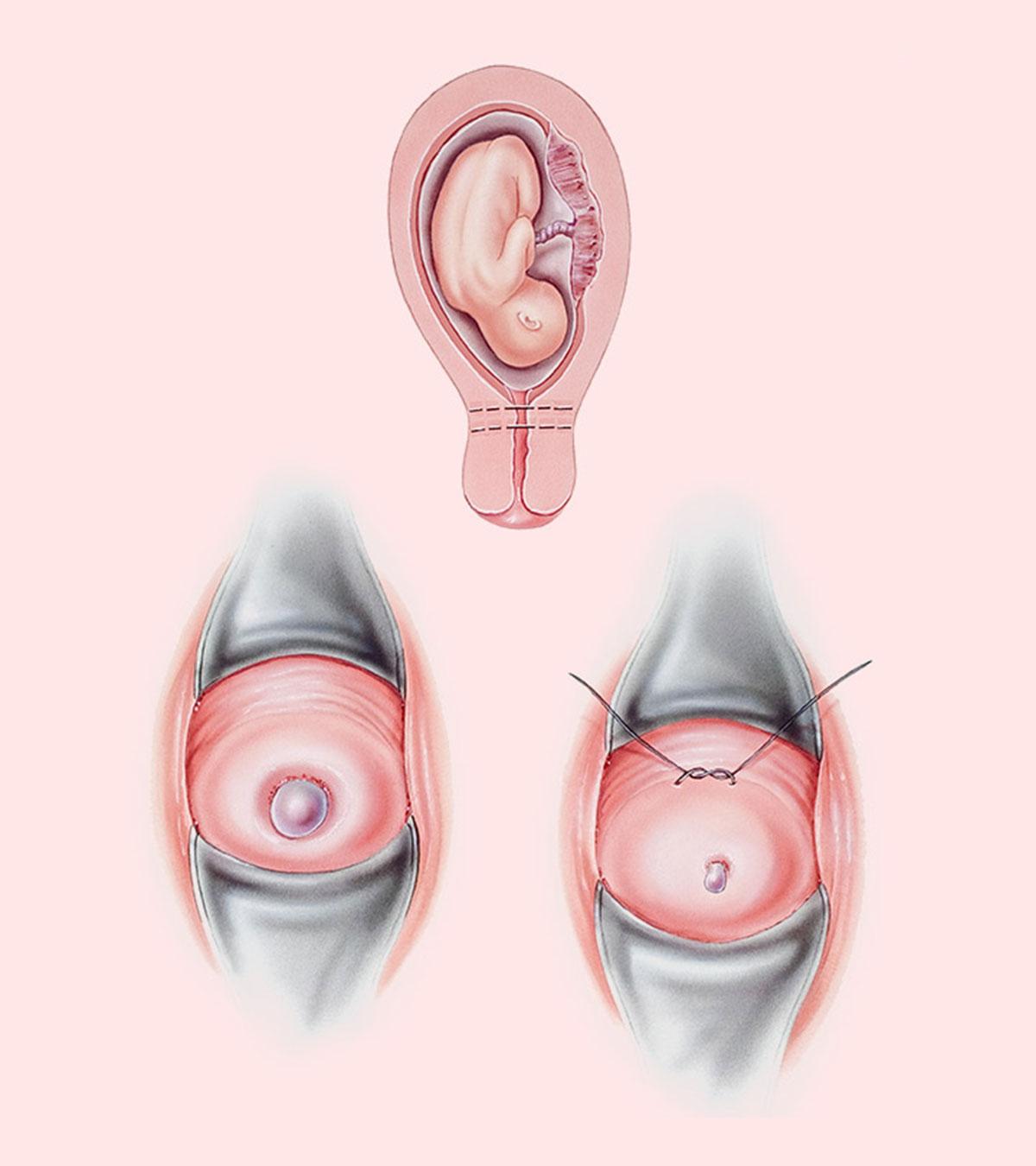 Cervical Cerclage: Why And How It Is Done During Pregnancy