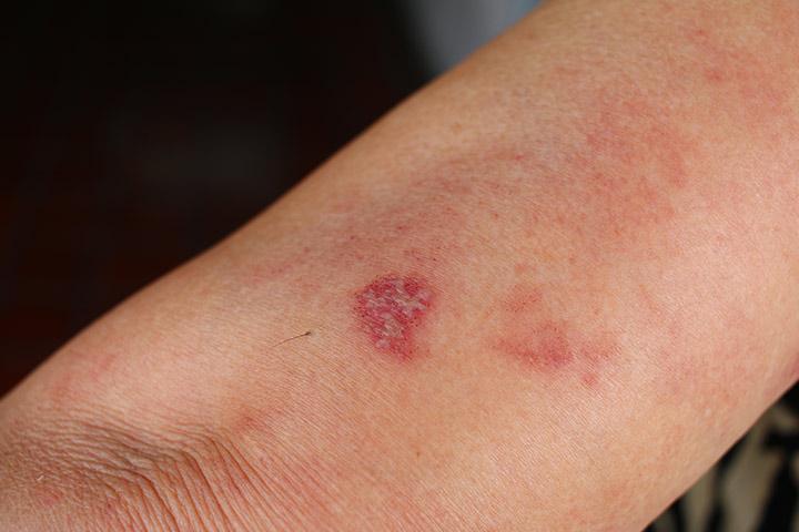 Exposure To Shingles While Pregnant: Are You At Risk And How To Avoid It?