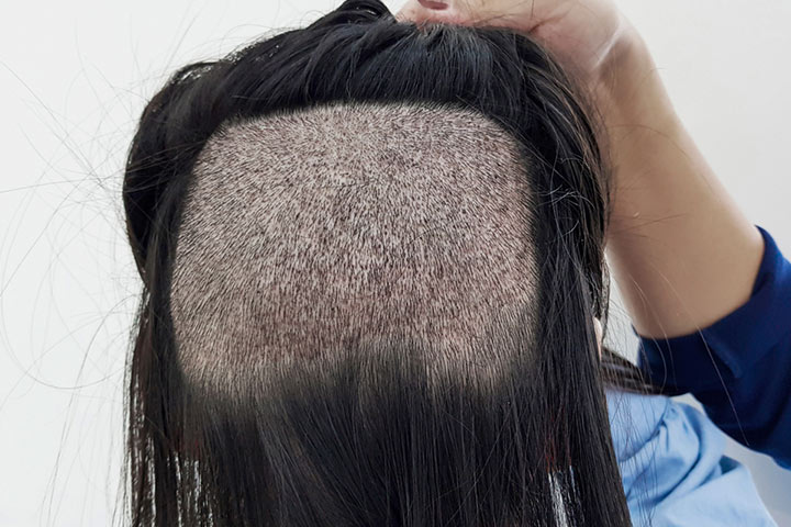 Discover 147+ reasons for severe hair loss latest