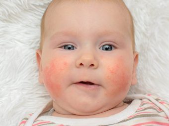 12 Symptoms Of Egg Allergy In Babies And Their Treatment