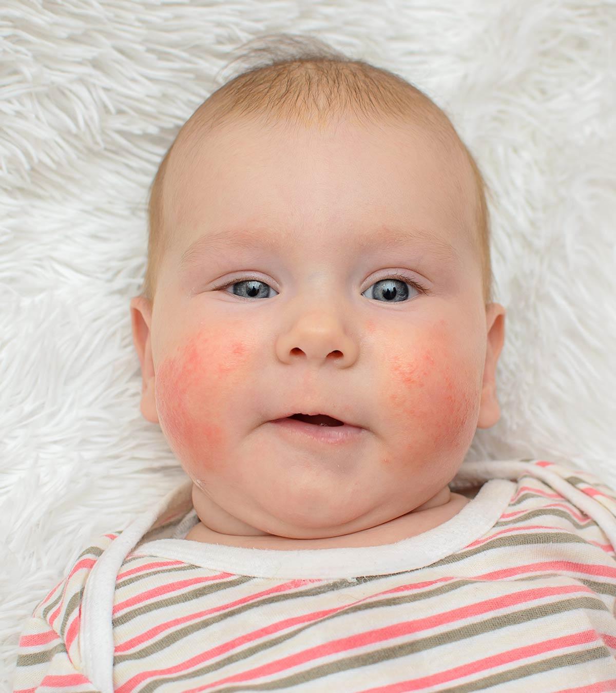 12 Symptoms Of Egg Allergy In Babies And Their Treatment