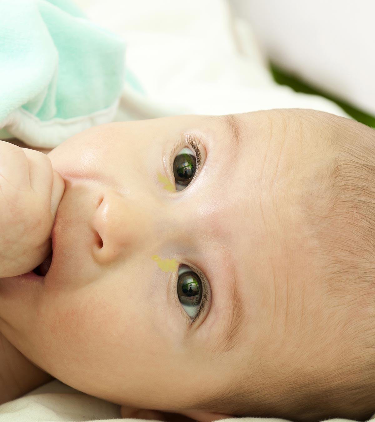 Infants Suffering From Sticky Eyes