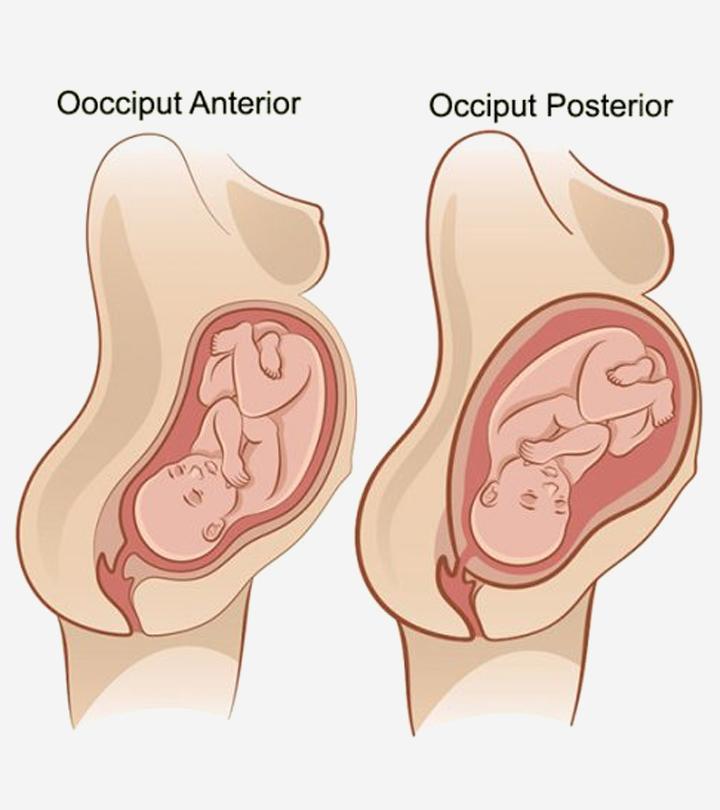 Causes Of Occiput Posterior Position And Management Tips