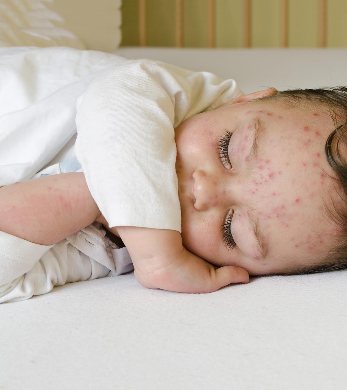 A baby suffering from chickenpox