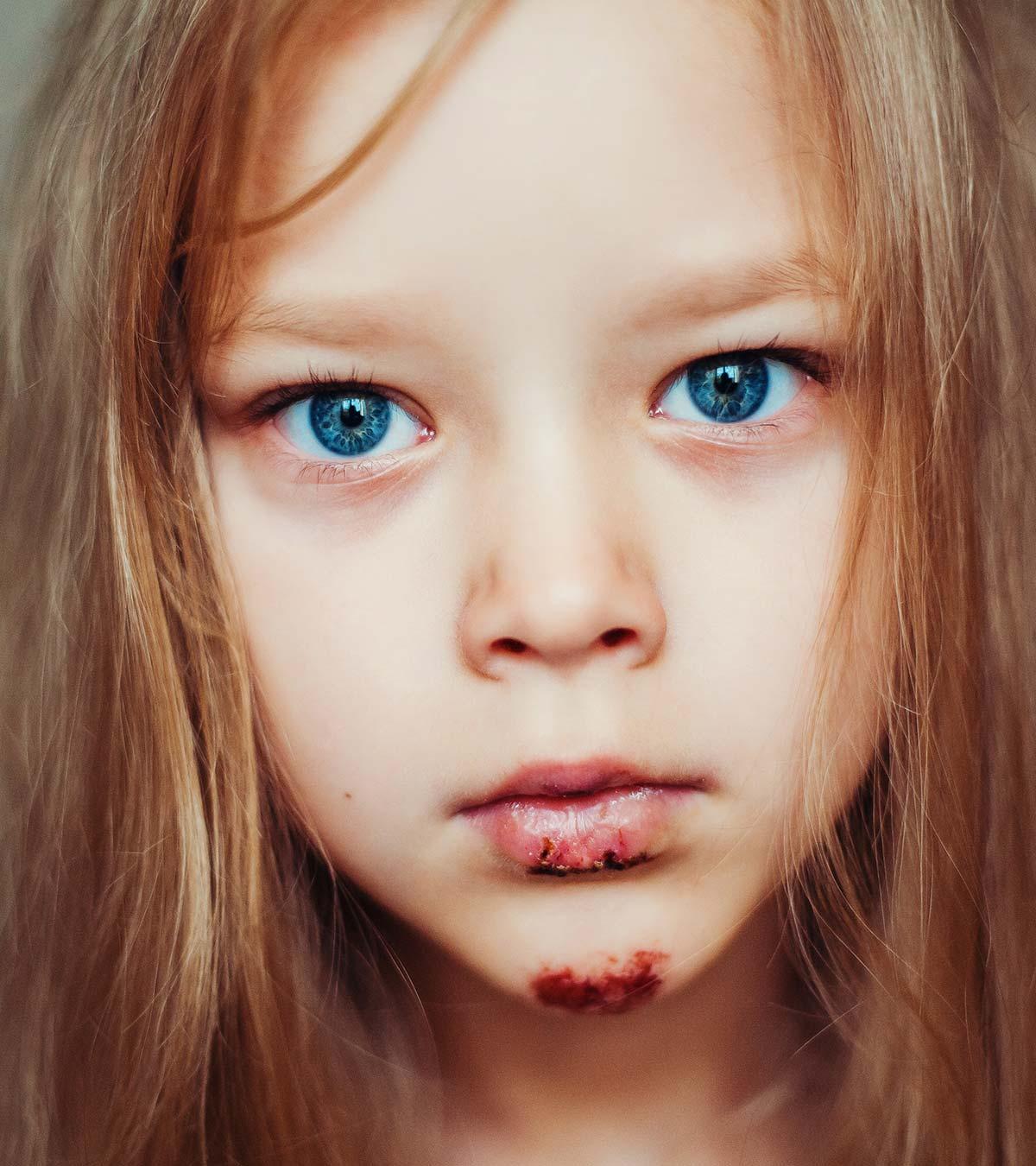 Child Injured Due To Dog Bites