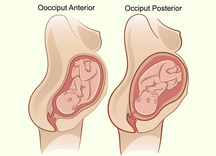 posterior presentation in labour