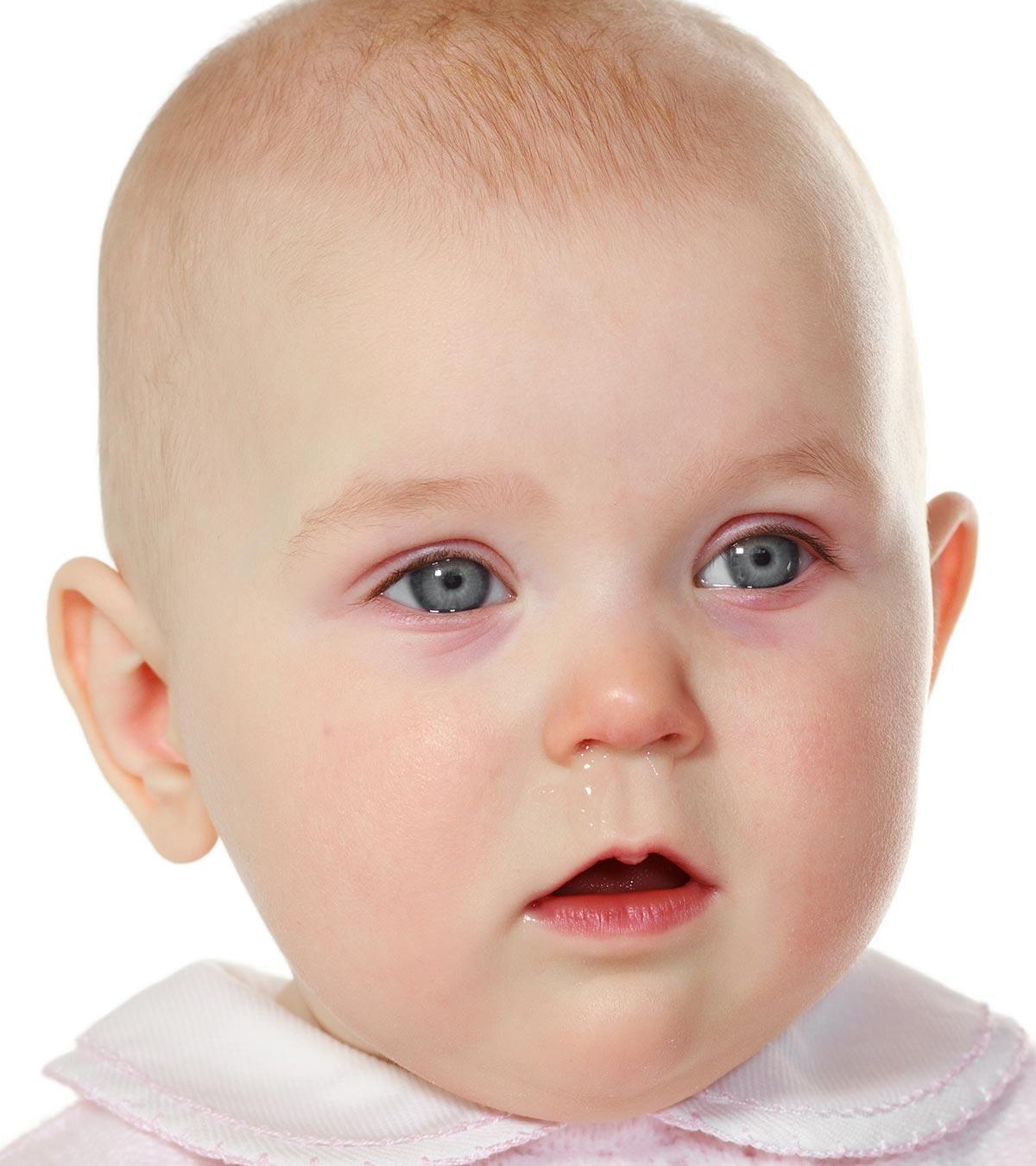 Pink Eye In Babies
