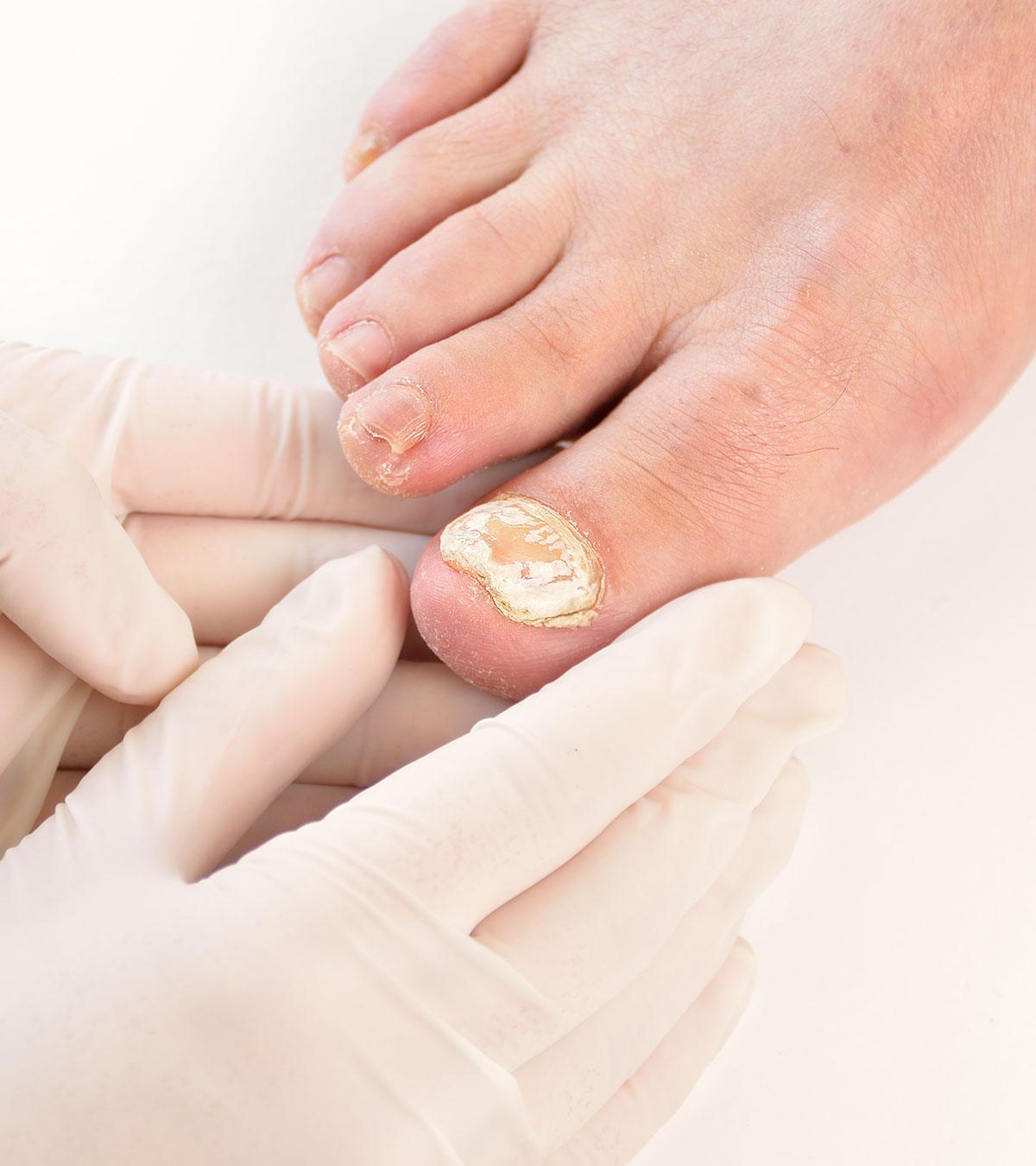 Pregnant Women Suffering From Toenail Fungus