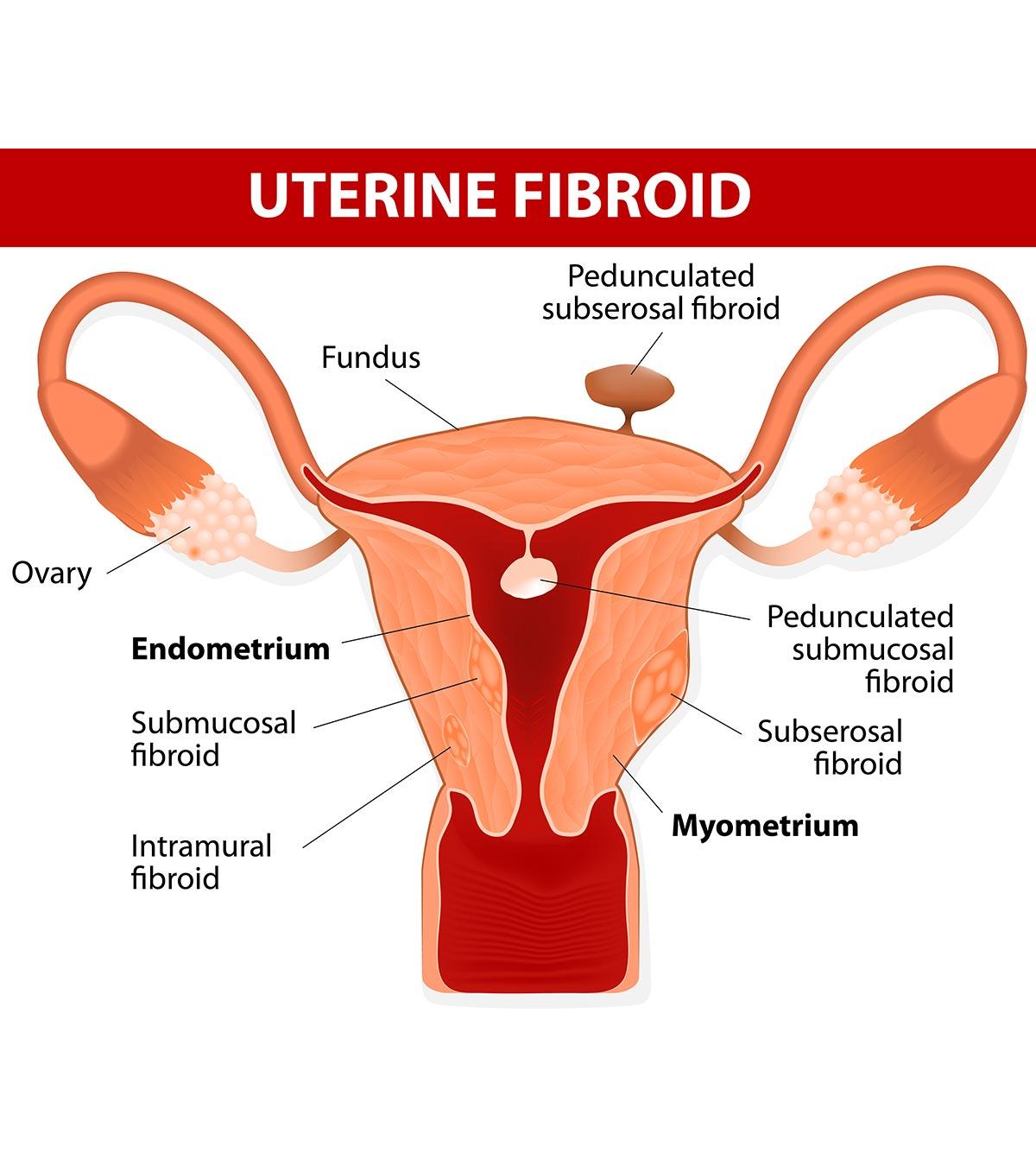 Uterine fibroids diagram