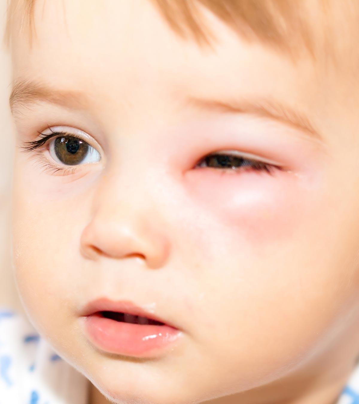 Symptoms And Causes Of Periorbital Cellulitis In Children