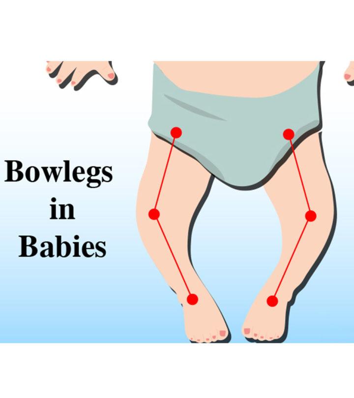 Bow Legged Baby Causes, Symptoms, Treatment And Prevention
