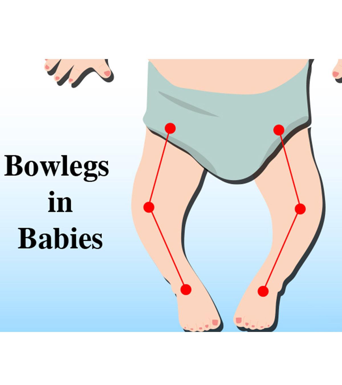 What Are Bowed Legs In Babies? Causes And Treatment