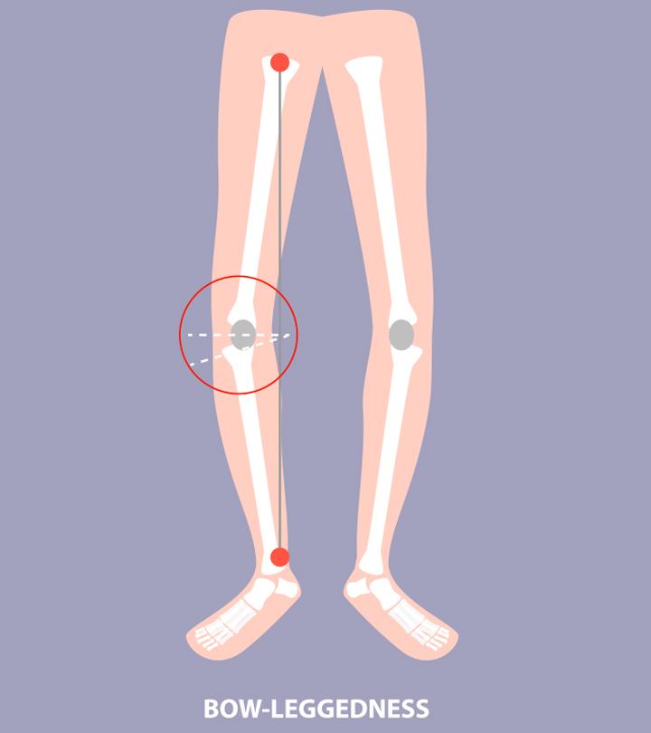 Treatment For Bowed Legs In Babies