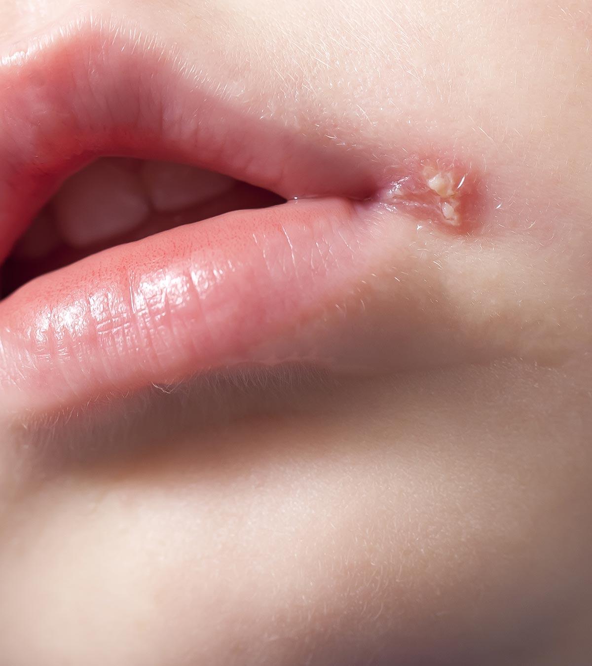 Cold Sores In Babies: Causes, Risk, Treatment & Prevention