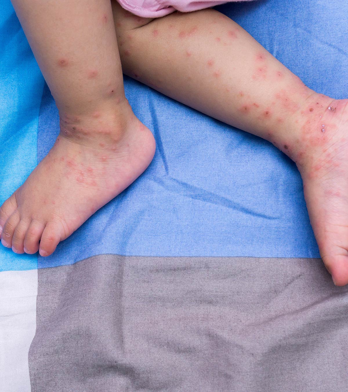 6 Symptoms And Causes Of Hand, Foot And Mouth Disease In Babies