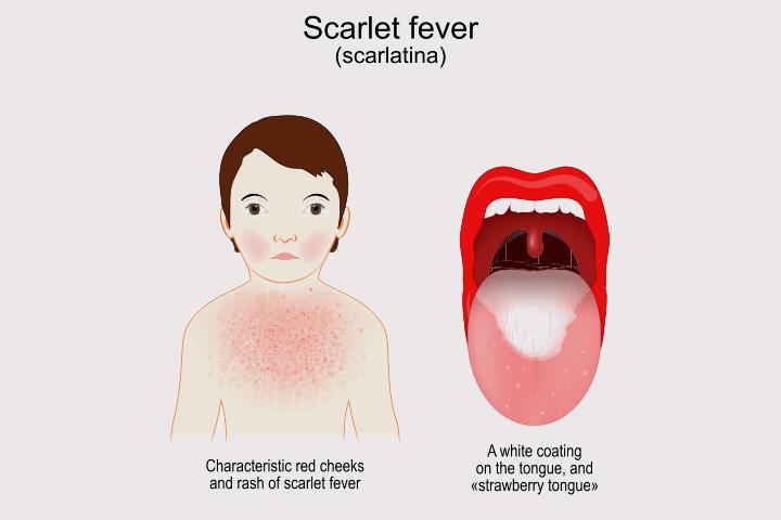 Parents and carers asked to be aware of the symptoms of scarlet fever