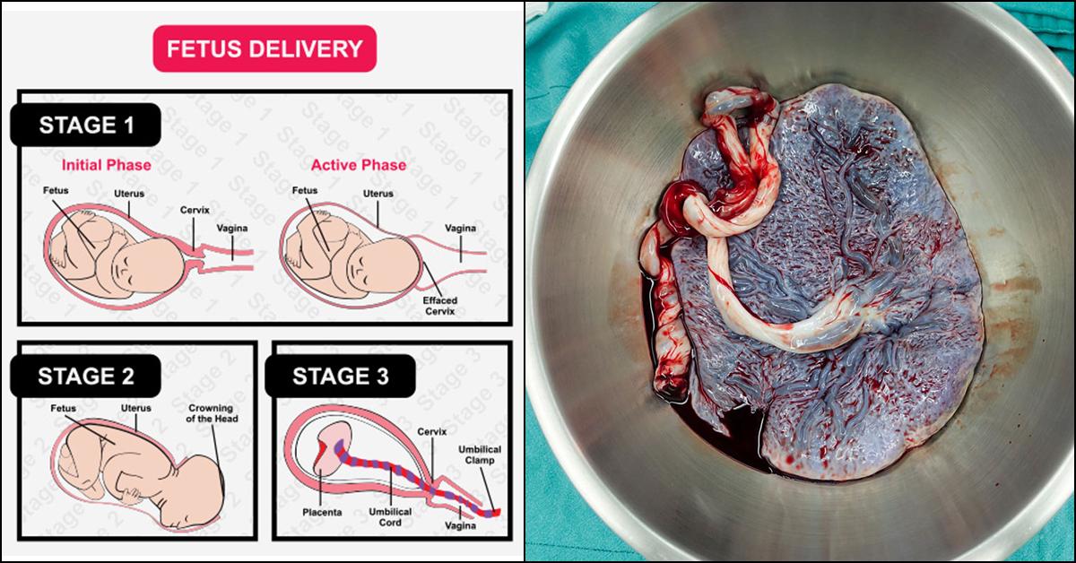 Retained Placenta: Causes, Symptoms, And Treatment
