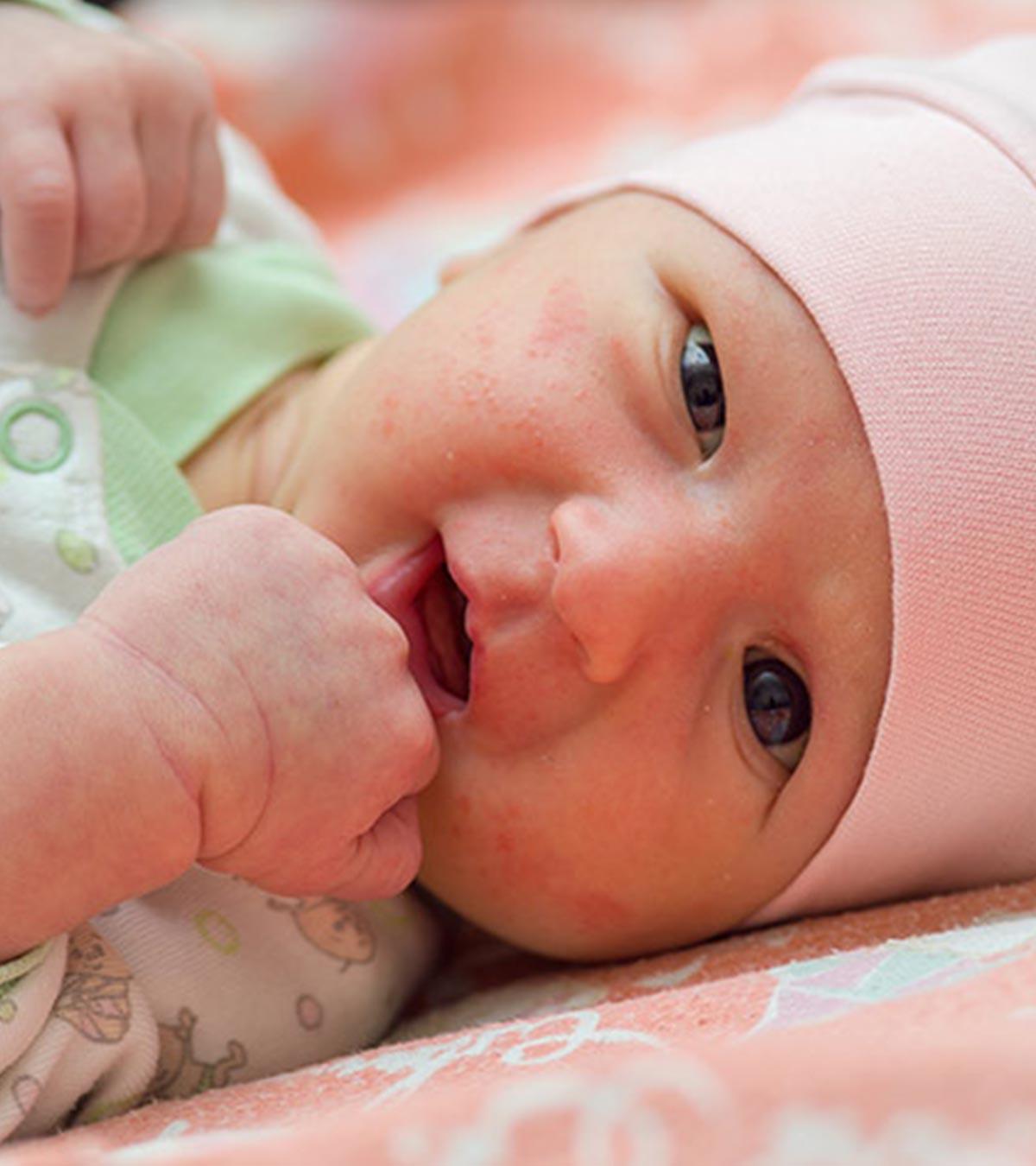 A Baby Suffering From Scarlet Fever