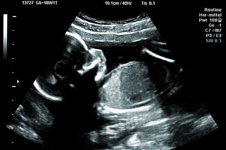 Baby Gender Prediction: Am I Having a Boy or Girl?? – Happiest Baby