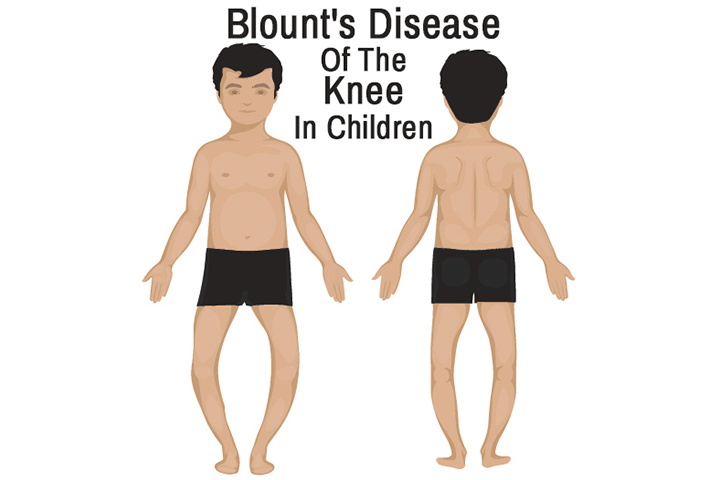 Blount Disease In Children – Causes, Symptoms And Remedies