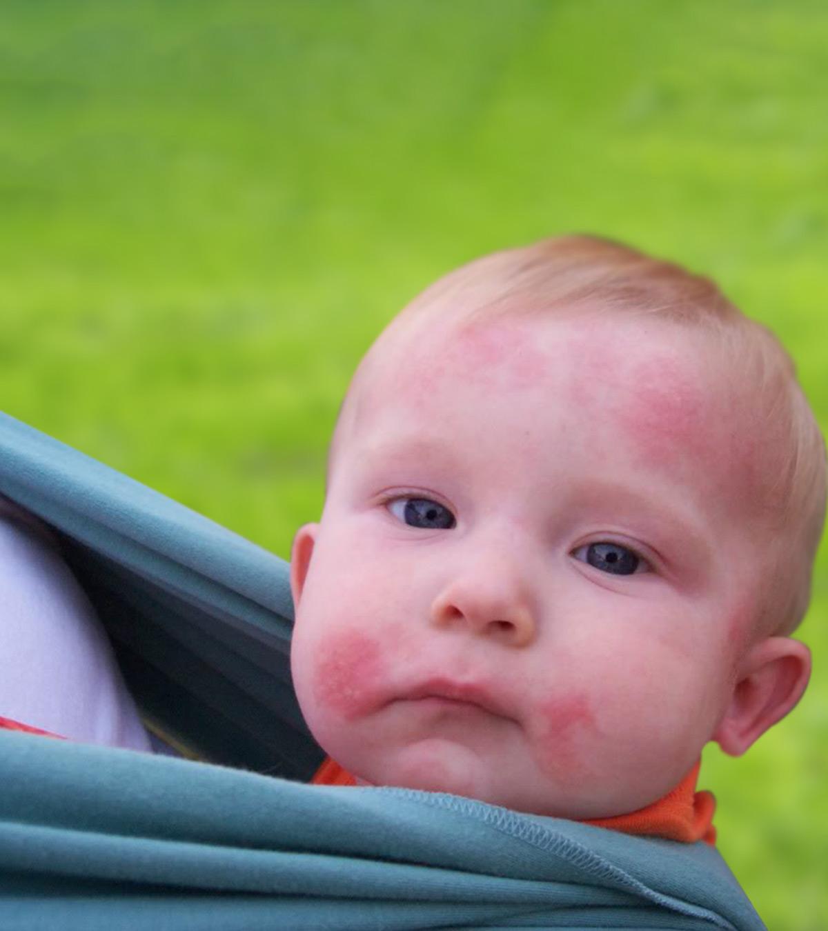 Baby Suffering From Ringworm