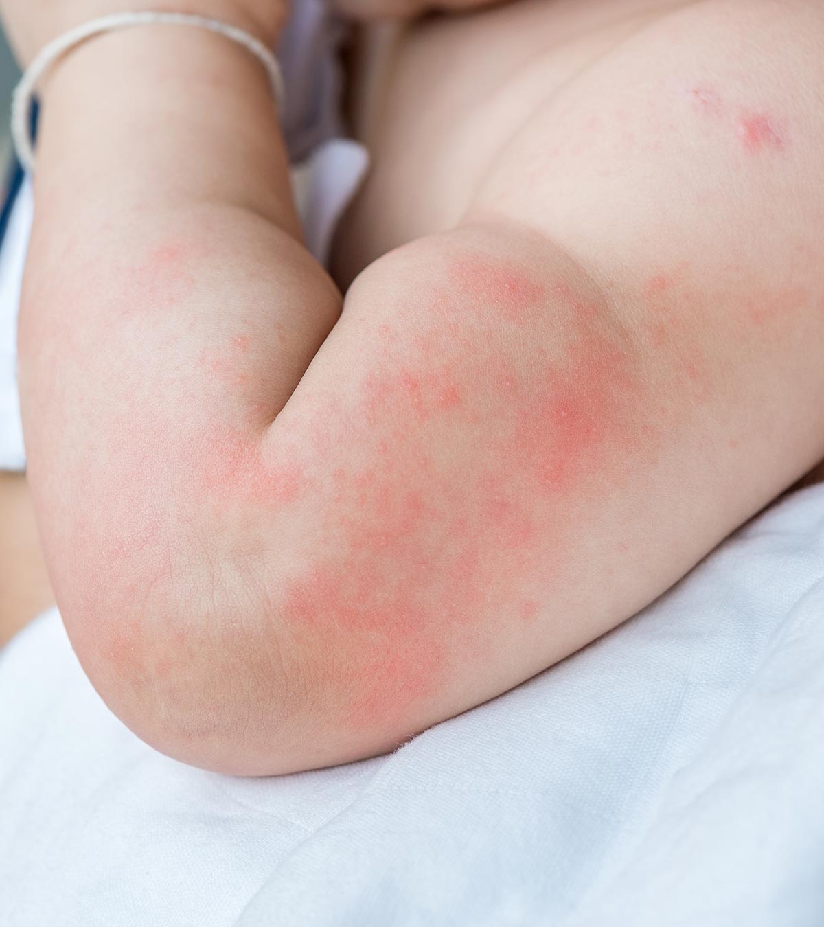 Hives On Baby: Causes, Symptoms, Treatment And Prevention
