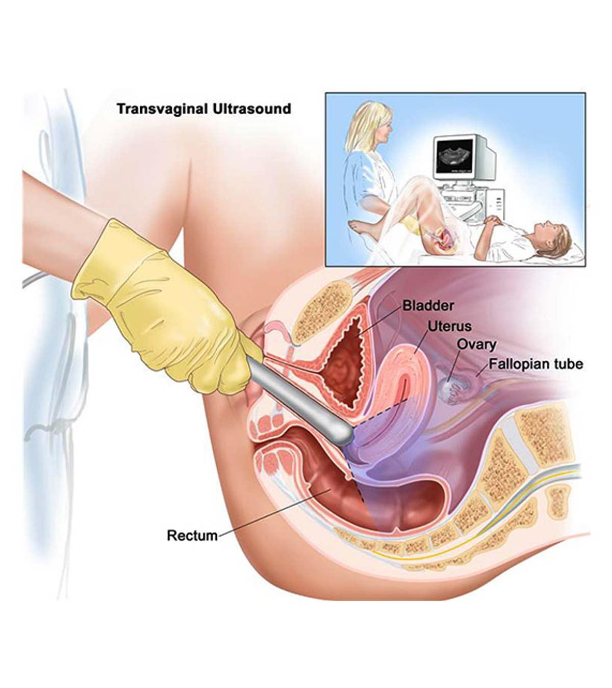 A gynecologist performing a transvaginal scan on a pregnant lady