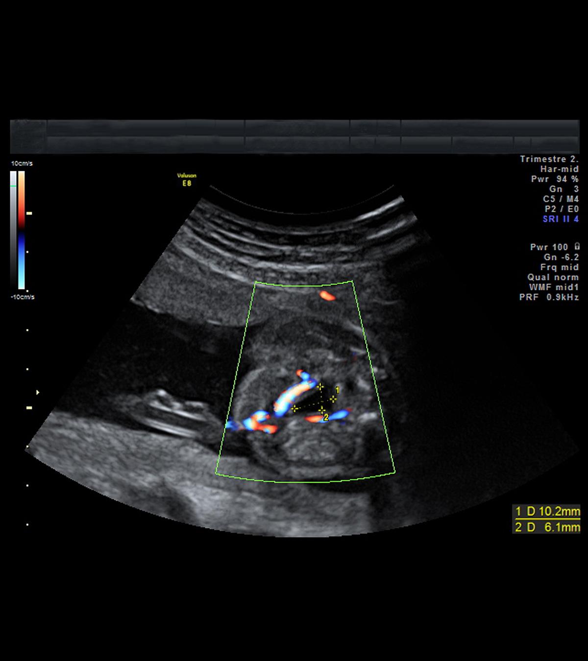 Two-Vessel Cord: Its Causes, Risk Factors And Effects On Baby