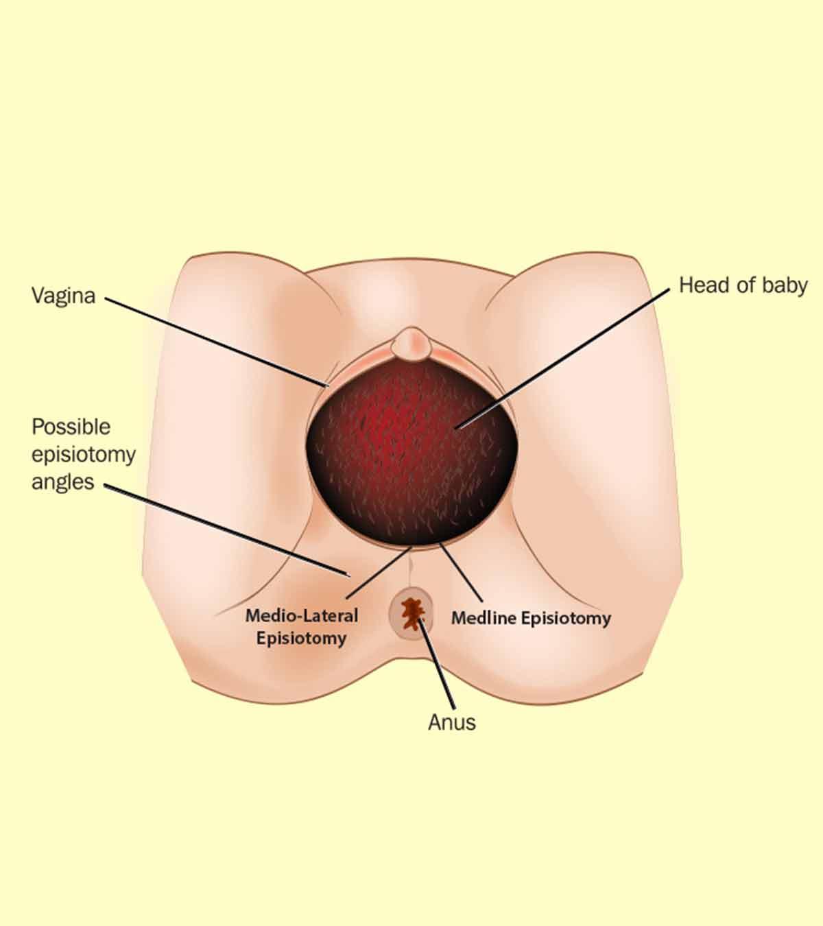 What Is Episiotomy And How To Take Care After Delivery