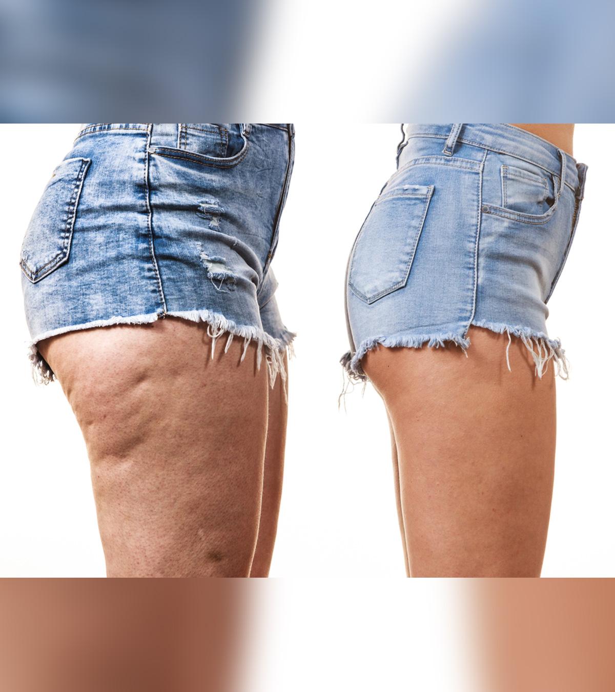 Cellulite In Teens: Causes And Treatment Options To Get Rid Of It