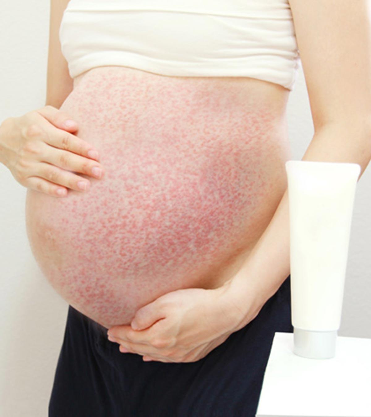 A Pregnant Woman SUffering From PUPPP Rash
