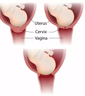 8 Cervix Changes During Birth or Labor And Complications