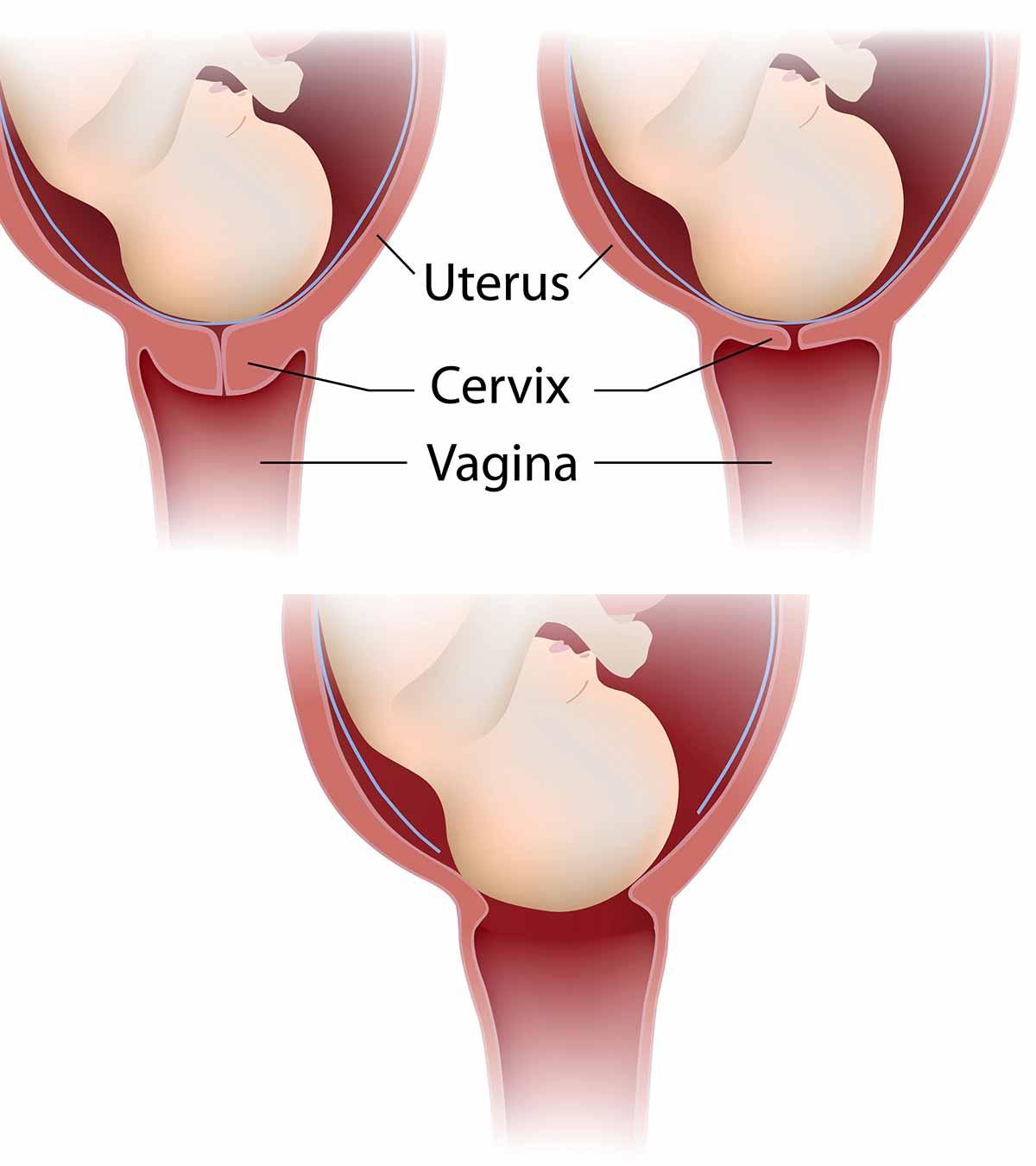 Cervix diagram during birth