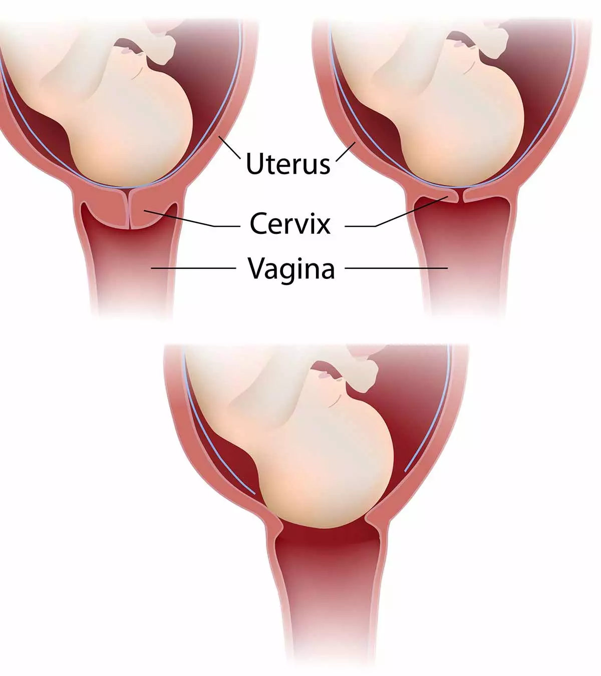cervix 8 Cervix Changes During Birth or Labor And Complications