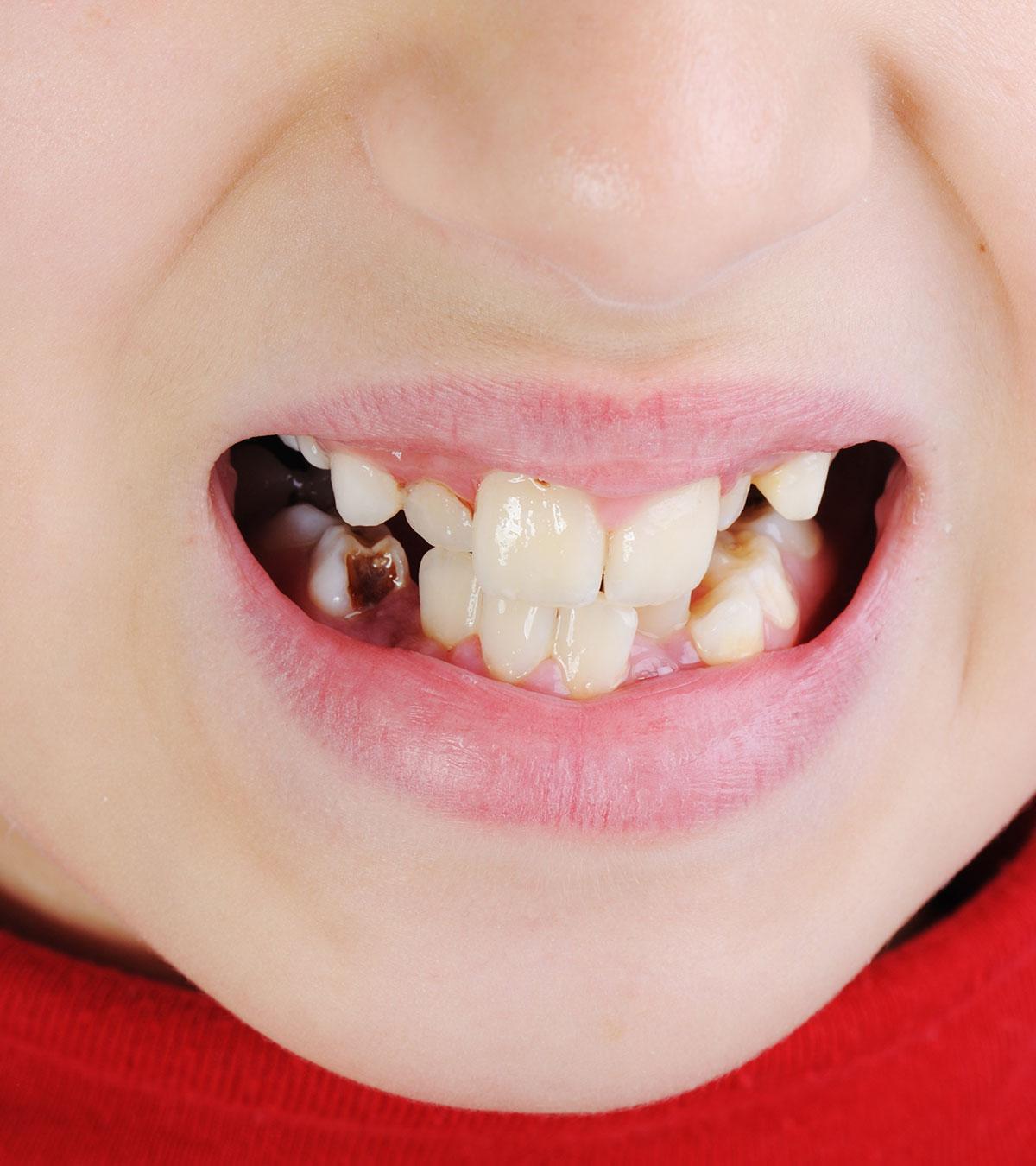 Child With Discolored Teeth