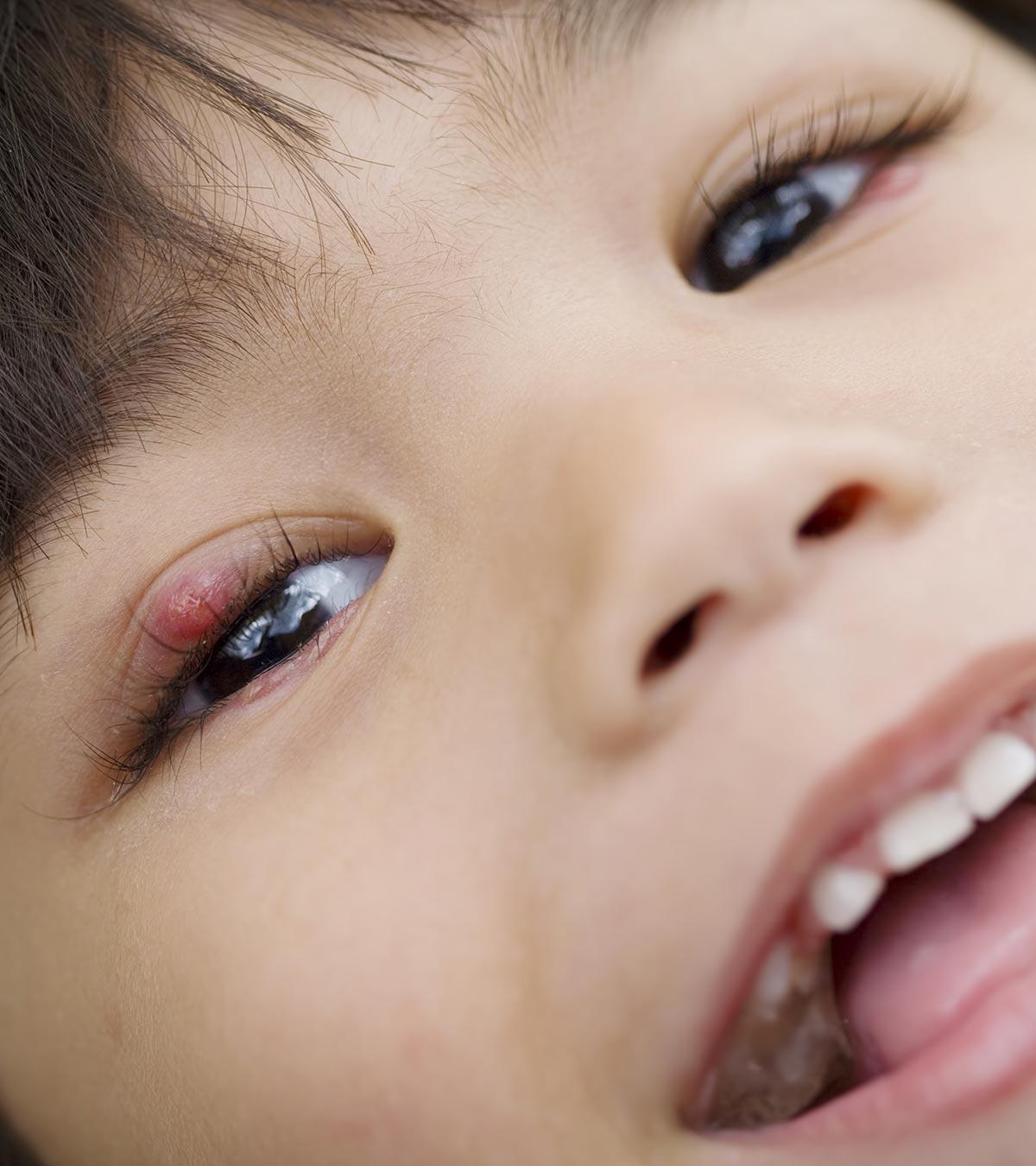 Stye in a baby