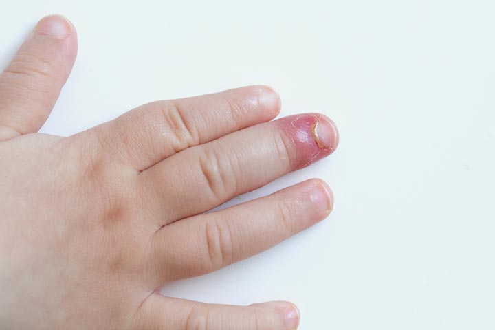 5 Best Ways To Remove Splinter From A Child's Skin