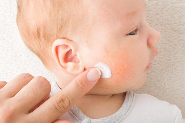 Baby fungal infection sales cream